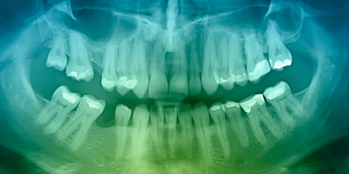 Dental X-ray