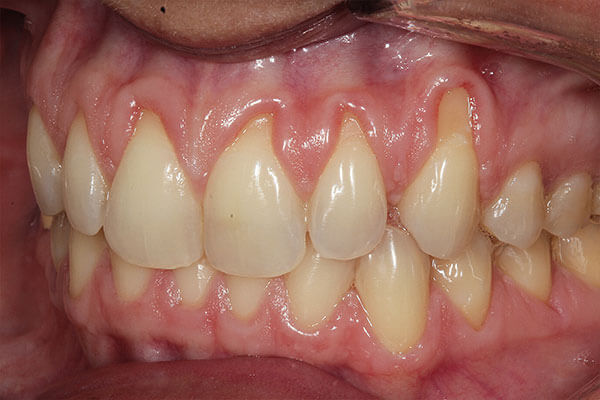 Gum Graft | Bayside Periodontics & Dental Implants