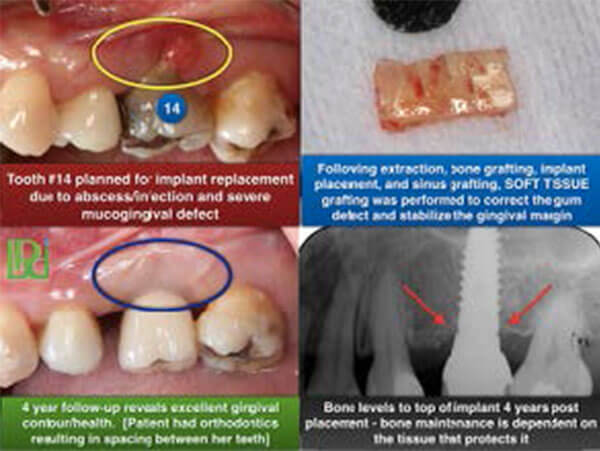 Know how graft you a do failed gum if Skin Graft